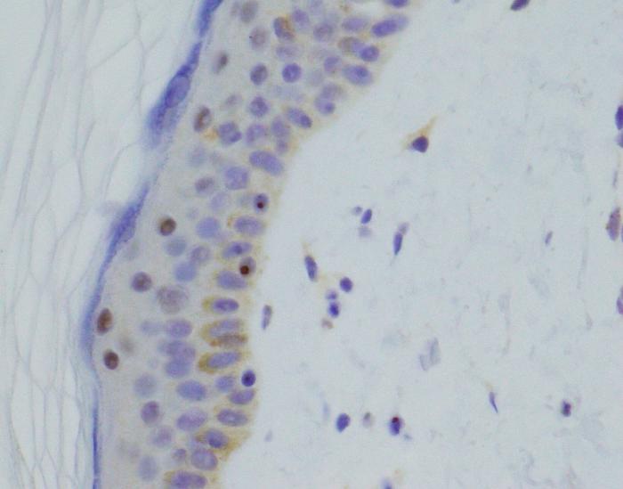 Cell microscopy confirming the new DNA test’s diagnosis