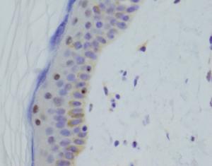 Cell microscopy confirming the new DNA test’s diagnosis