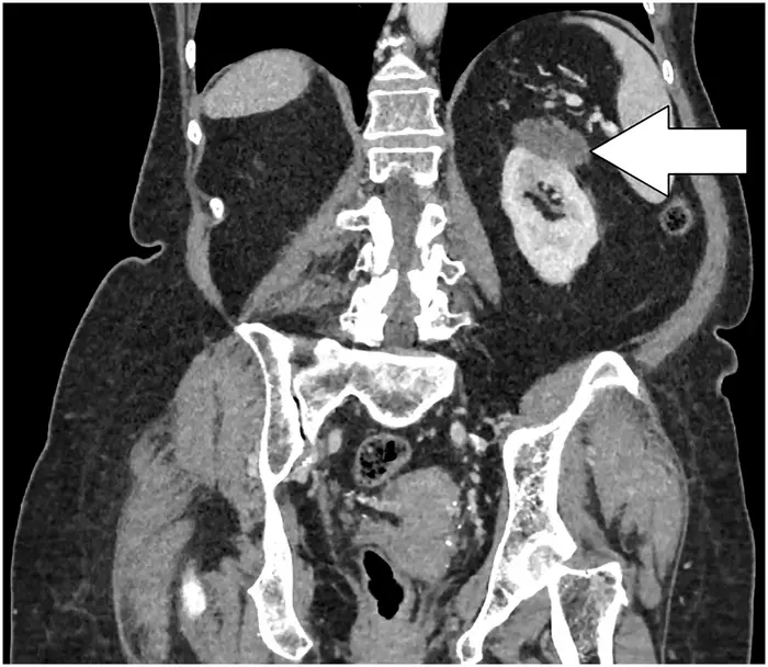 Renal oncocytoma: Α case report and literature review