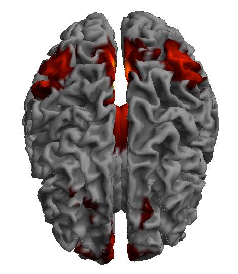 Resting-State Functional MRI