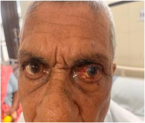 Sebaceous adenoma of the eyelid: A clinical, histopathological, and immunohistochemical perspective