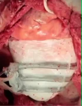 Sleeve Compresses the Heart