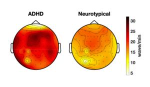 Sleep-like brain activity differences.
