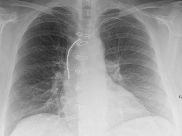 MRI Safely Performed in Patients with Pacemakers and ICDs