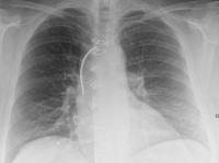 MRI Safely Performed in Patients with Pacemakers and ICDs