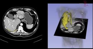 AI model ARTIMES measures the entire volume of a tumor (video still)