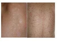 Two Skin Diseases Caused by <i>Malassezia</i> Yeasts