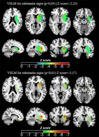 Iron Measurements with MRI Reveal Stroke's Impact on Brain (3 of 3)