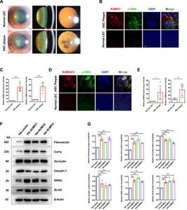 SUMOylation is elevated in human anterior subcapsular cataract (ASC) and drives the epithelial-mesenchymal transition (EMT) of lens epithelial cells (LECs).