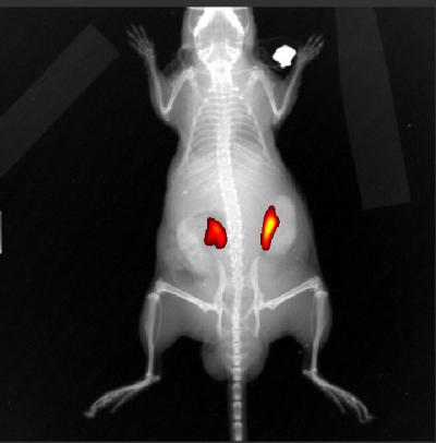 Prostate Tumors