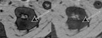 b. 64-Year-Old Man With Clear Cell Likelihood Score (ccLS) 5 Renal Masses