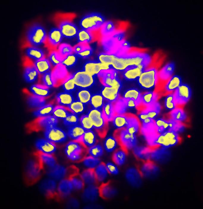 An AI to predict the risk of cancer metastases