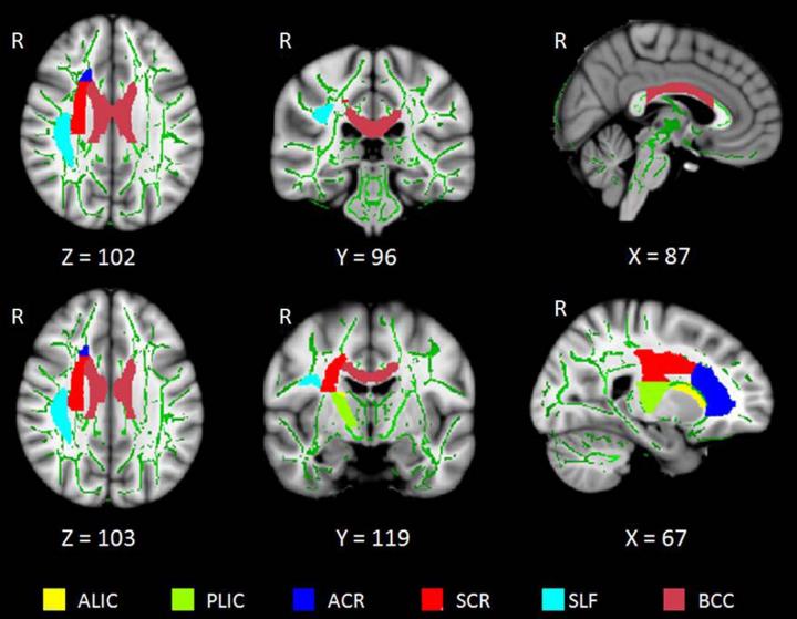 WM Tracts in Brain