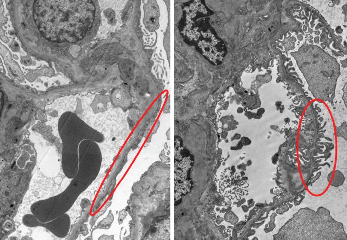 Healthy versus damaged podocytes