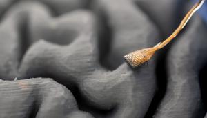 3D Model of Implant