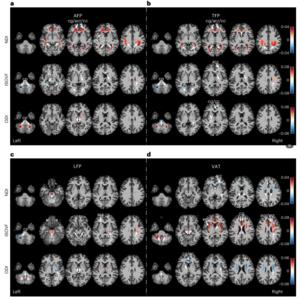 PolyU research reveals fat distribution as key to brain health, with visceral fat accumulation significantly accelerating brain ageing and showing much stronger association than BMI