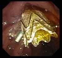 Coated Self-Expanding Metallic Stent in Place