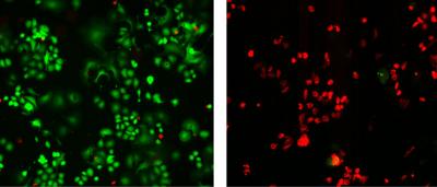 HER2 Breast Cancer Tumor Cells