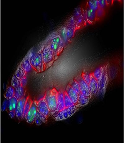 Some Aggressive Cancers May Respond to Anti-inflammatory Drugs