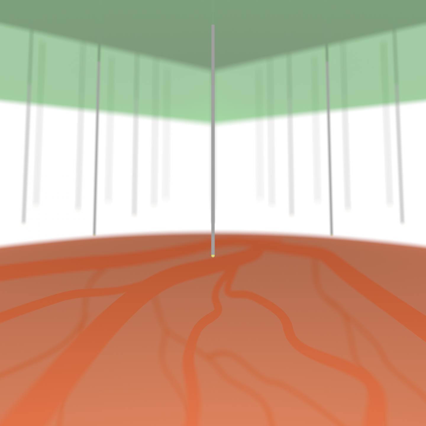Microneedles 