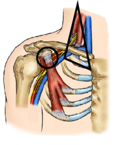 Surgeons Find Better Ways to Treat Nerve Compression Disorder that Can Sideline Athletes