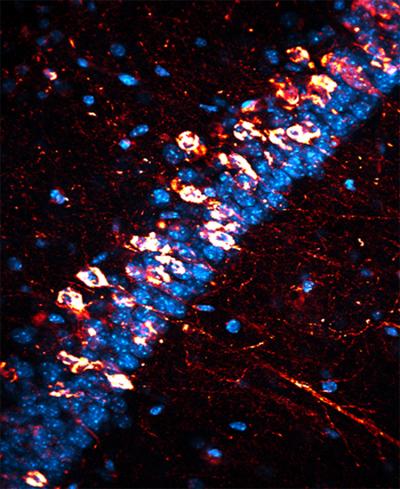 Neurofibrillary Tangles Are 1 of the Hallmarks of Alzheimer's Disease
