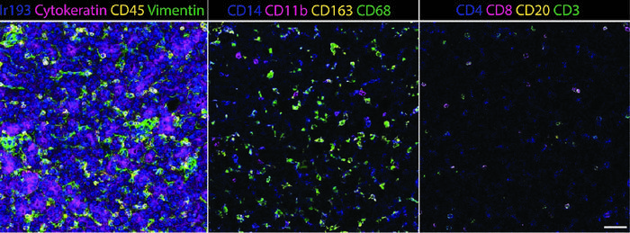 Imaging mass cytometry images showing many myeloid cells in hepatoblastoma