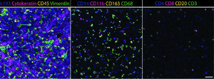 Imaging mass cytometry images showing many myeloid cells in hepatoblastoma