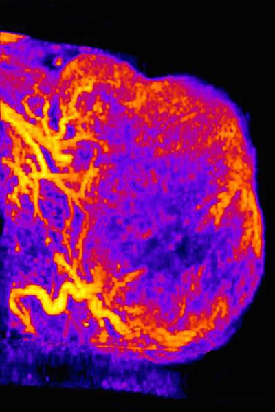 PECAM1-positive Tumor