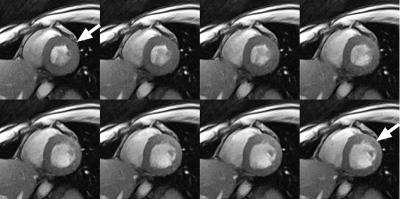 Real-time MRI