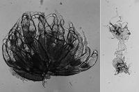 Genetic Mutations May Be Linked to Infertility, Early Menopause