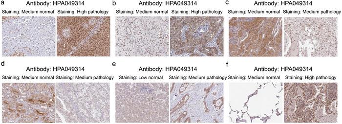 Representative Human Protein Atlas immunohistochemistry images of TMED3 in normal and tumor tissues