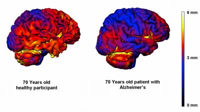 Dementia: Early Detection is Key