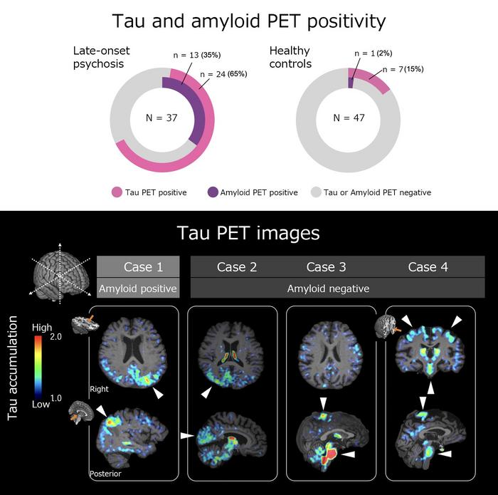 Tau and amyloid PET findings in late-onset psychosis.