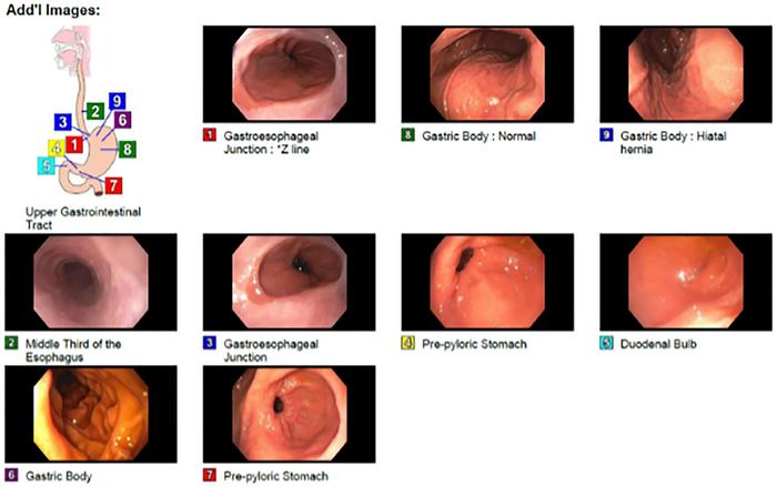 Unprecedented non-luminal esophageal adenocarcinoma invading the spine