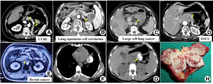Images of pancreatic metastases from different primary cancers
