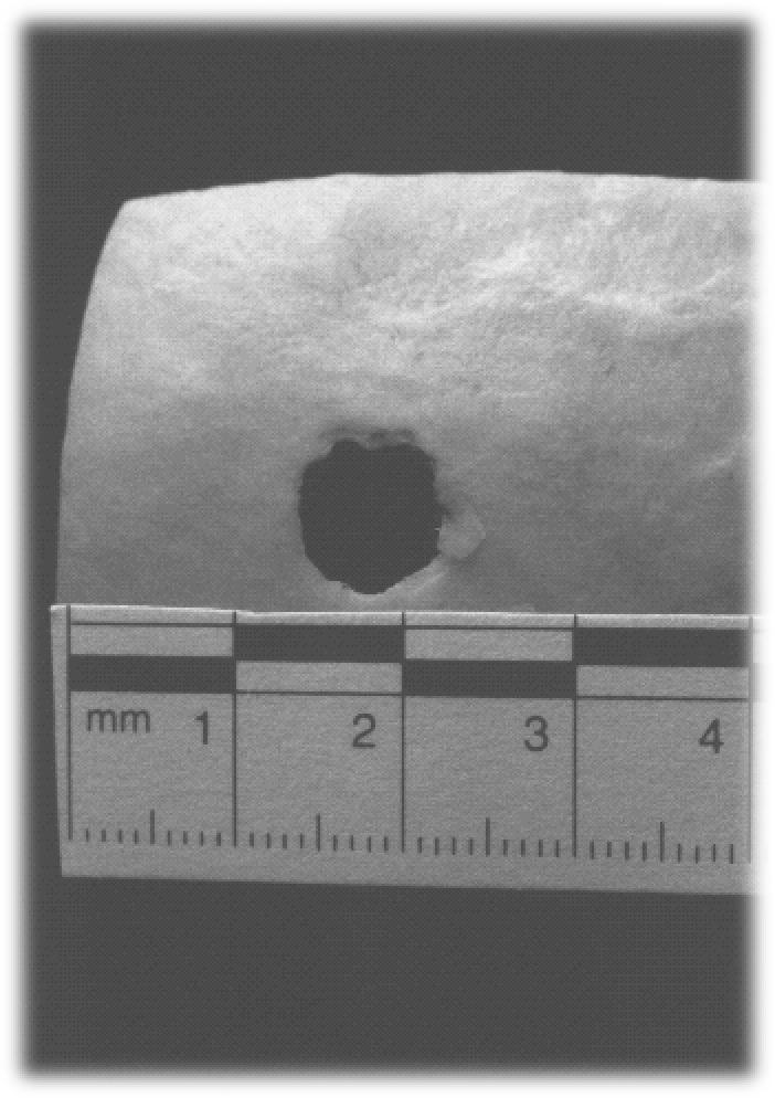 Bone Density Affects Size of Bullet Holes in Skulls
