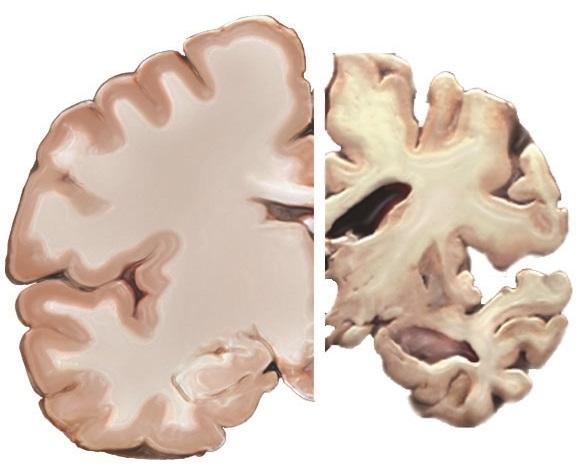 Brain