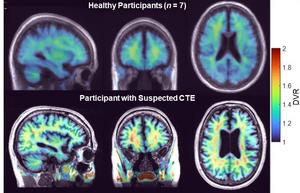 PET Suggests Potential CTE Biomarker in Living Humans