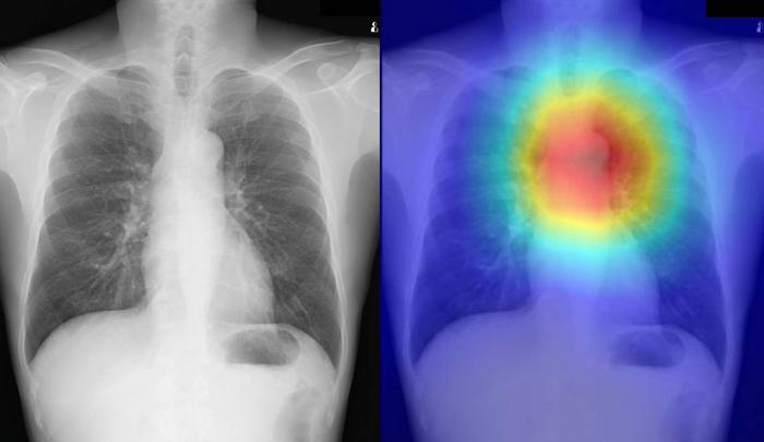 Heatmap overlay of X-ray images used for diagnosis of achalasia showing typical dilation seen in conditions like achalasia