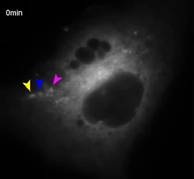 Polyomavirus Infection