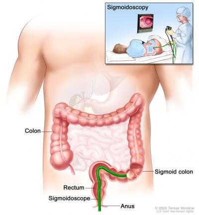 Sigmoidoscopy