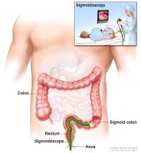 Sigmoidoscopy