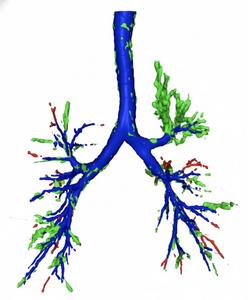 3D reconstruction of the airways generated from a CT scan using AI