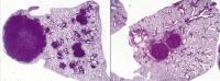 Tumors