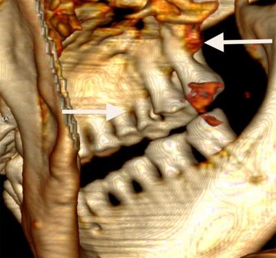 Ötzi -- the World's Oldest Wet Mummy (1 of 2)