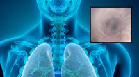 Bronchoscopy