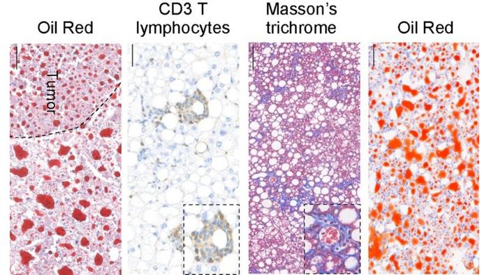 Hepatic remodeling and disease progression in fatty liver models
