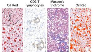 Hepatic remodeling and disease progression in fatty liver models