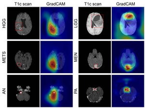 Deep Learning Model Classifies Brain Tumors with Single MRI Scan